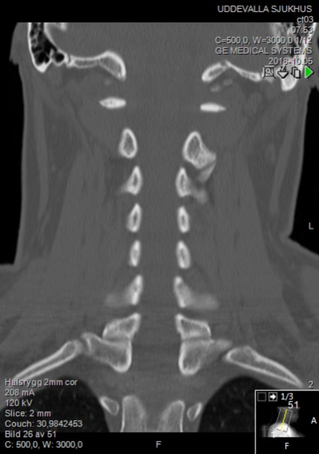 Eine MRT-Aufnahme des Halses eines Mannes, die einen Bruch zeigt, auf einem Computermonitor angezeigt.