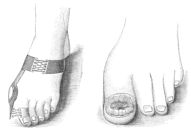 Schwarze und weiße Zeichnung von zwei Füssen, einer mit einem Verband und der andere mit einer sichtbaren Fraktur, mit Text unten, der die medizinische Behandlung angibt.